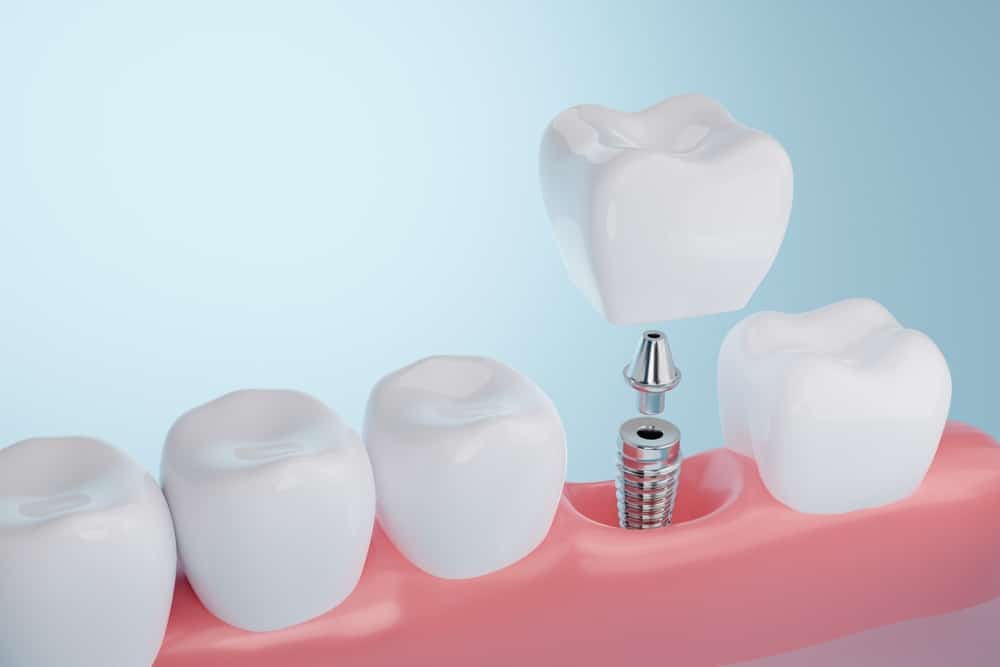 single tooth implant